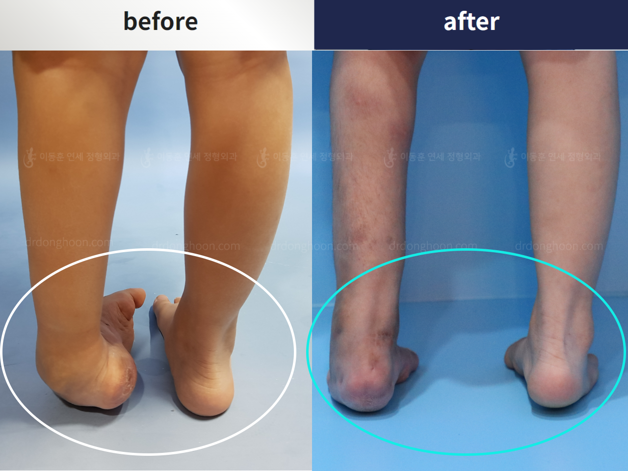 Before and after foot & ankle deformity, case 4367967, image 3, Dr. Donghoon institute (DALRI)
