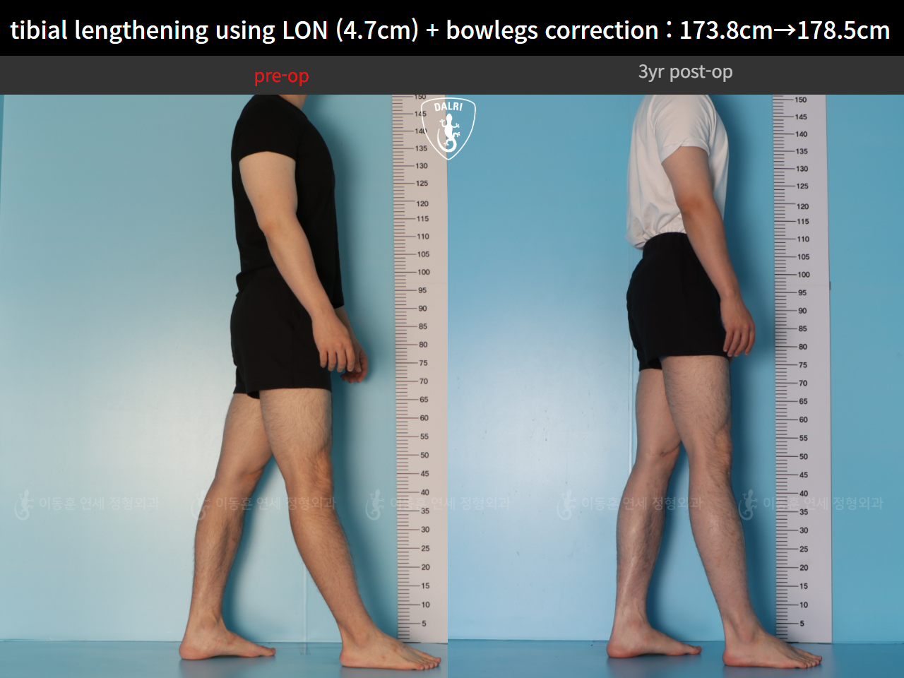 Before and after cll lon, case 128583026, image 5, Dr. Donghoon institute (DALRI)