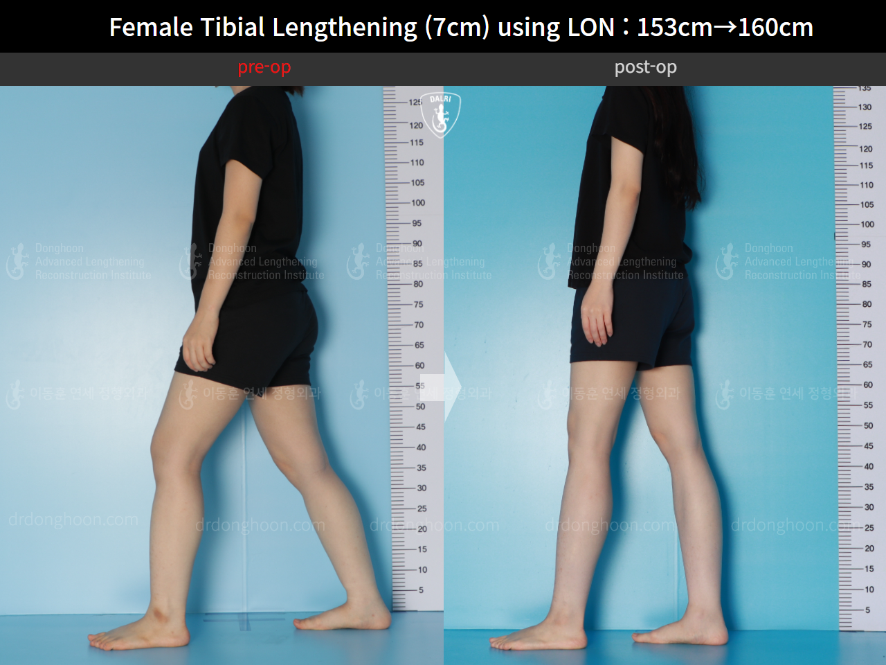 Before and after cll lon, case 16044134, image 3, Dr. Donghoon institute (DALRI)