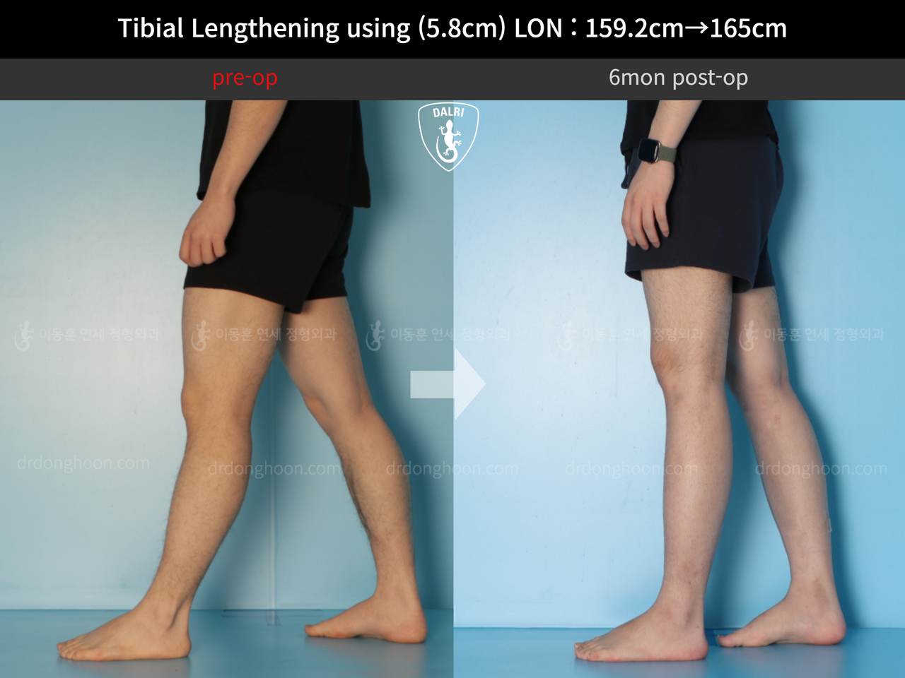 Before and after cll lon, case 12791053, image 7, Dr. Donghoon institute (DALRI)