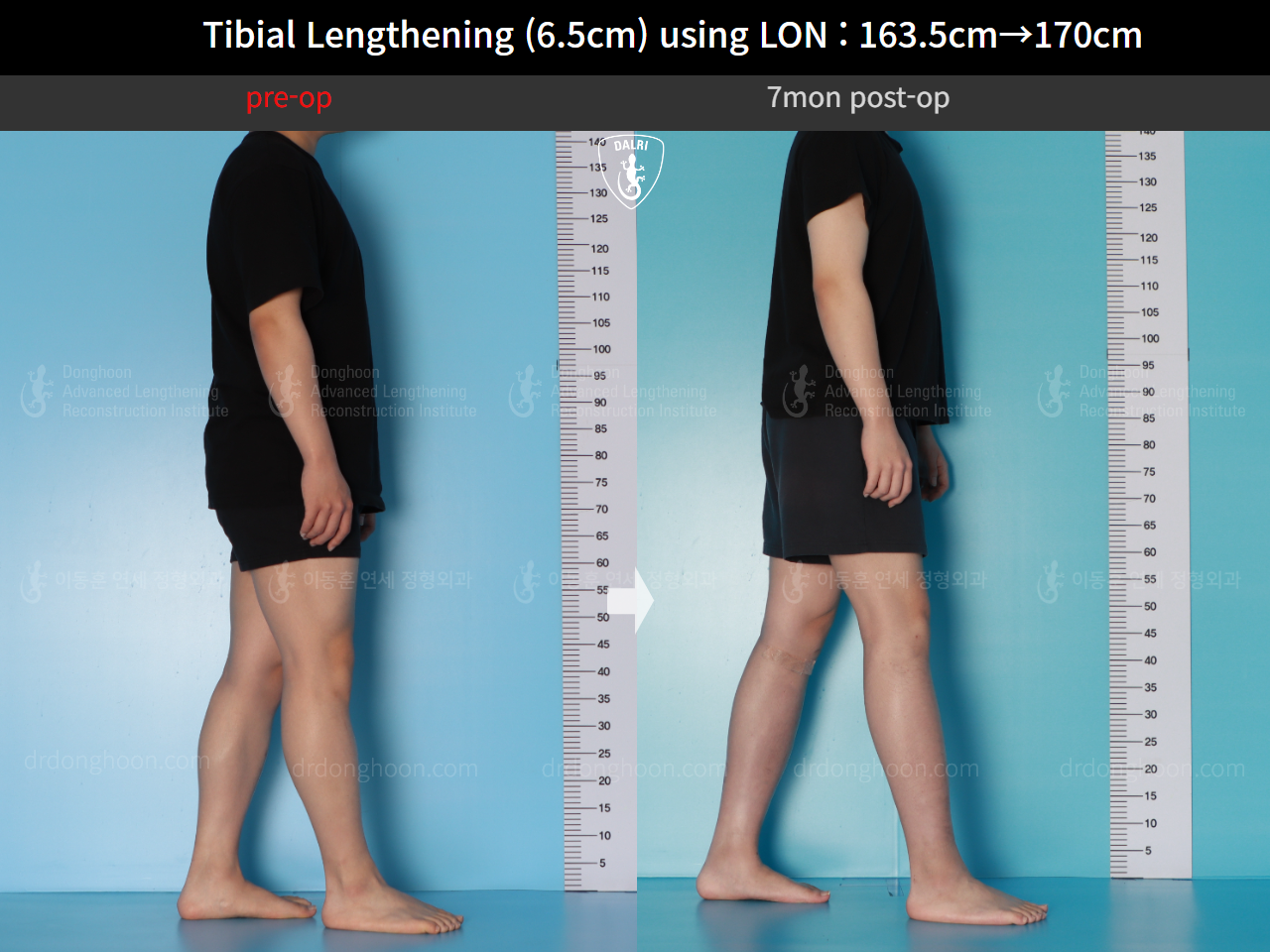 Before and after cll lon, case 17199046, image 4, Dr. Donghoon institute (DALRI)
