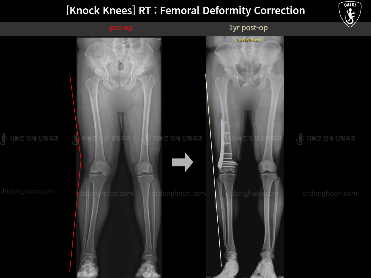 Before and after adult knock knees, case 15950751, image 15, Dr. Donghoon institute (DALRI)
