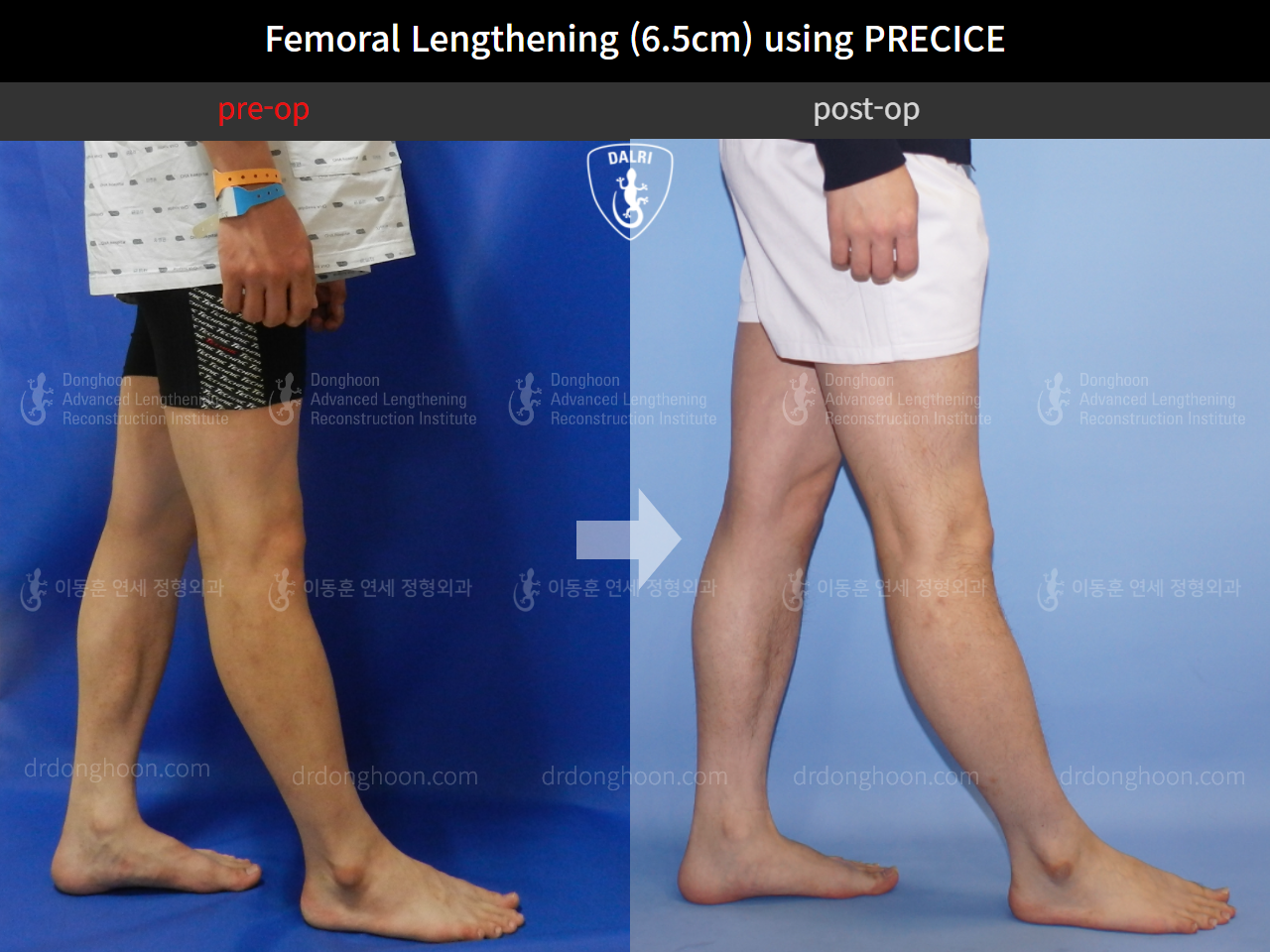 Before and after cll precice, case 4323401, image 8, Dr. Donghoon institute (DALRI)