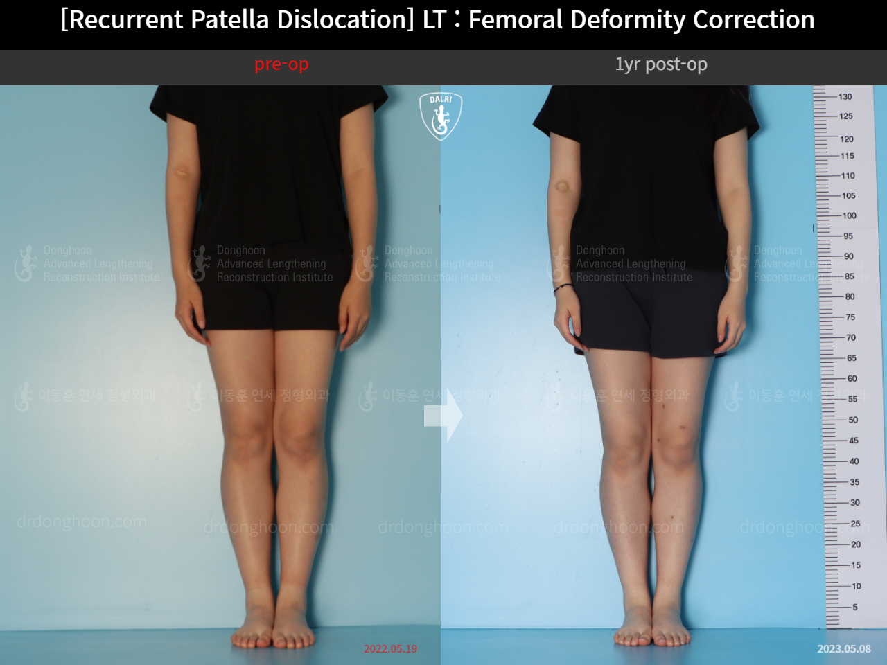 Before and after recurrent patella dislocation, case 15125370, image 2, Dr. Donghoon institute (DALRI)