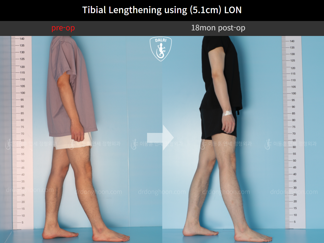 Before and after cll lon, case 9657314, image 4, Dr. Donghoon institute (DALRI)