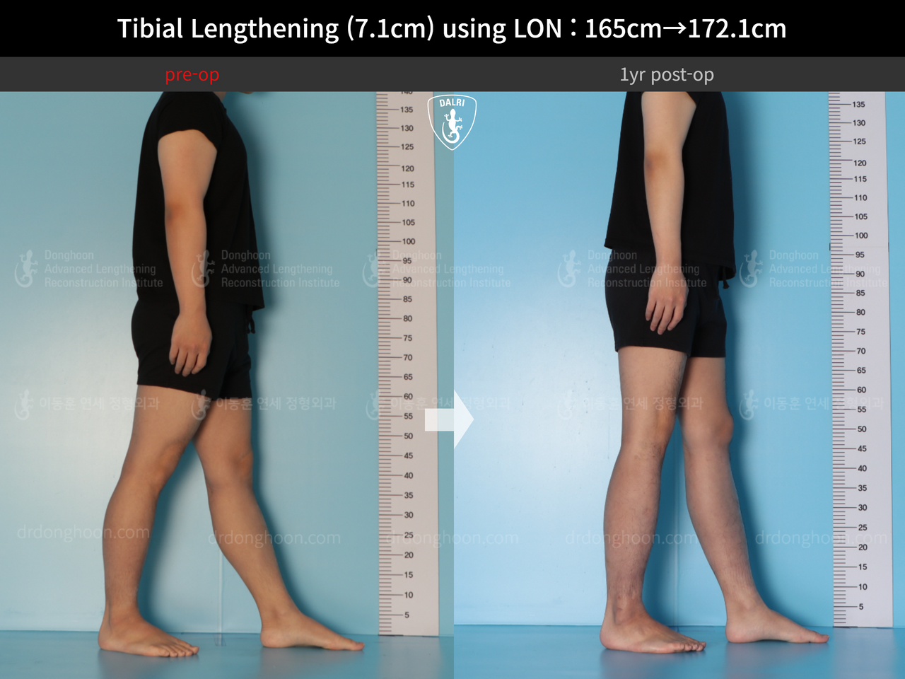 Before and after cll lon, case 14318674, image 4, Dr. Donghoon institute (DALRI)