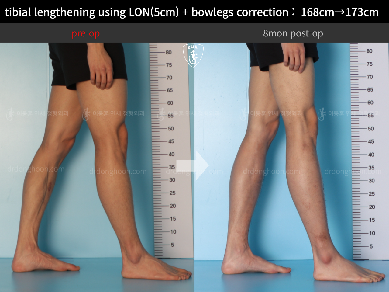 Before and after cll lon, case 13661175, image 9, Dr. Donghoon institute (DALRI)