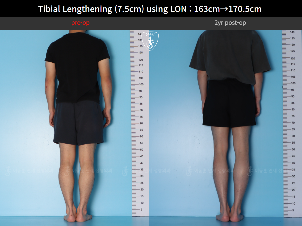 Before and after cll lon, case 125785462, image 3, Dr. Donghoon institute (DALRI)