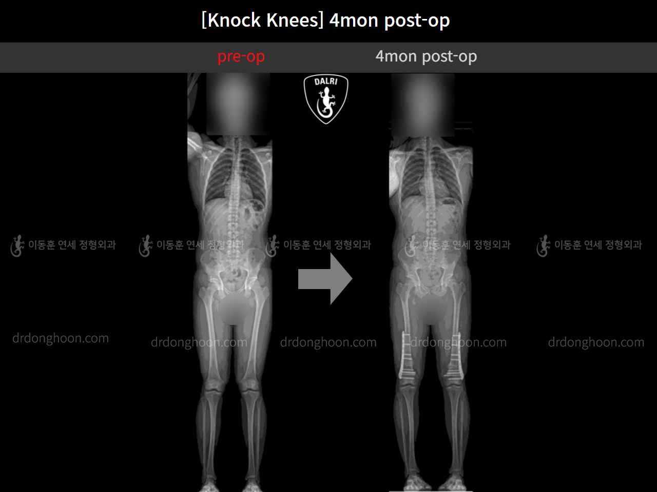 Before and after adult knock knees, case 10599771, image 8, Dr. Donghoon institute (DALRI)