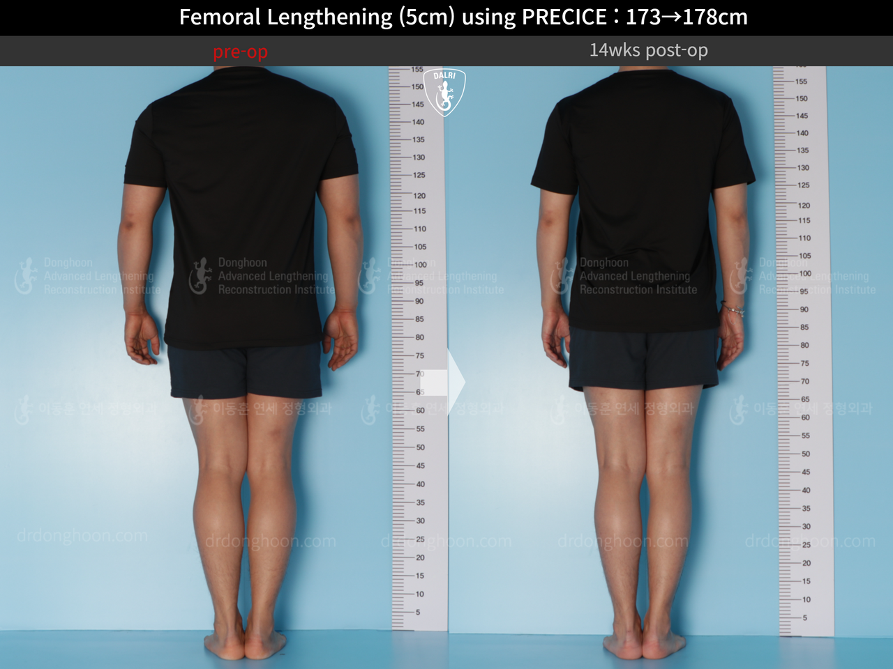 Before and after cll precice, case 14448457, image 2, Dr. Donghoon institute (DALRI)