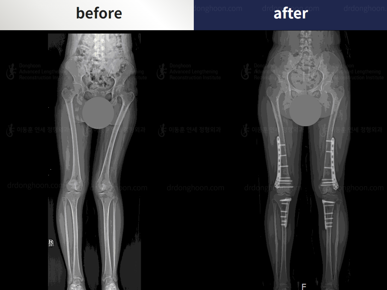 Before and after adult knock knees, case 5909547, image 1, Dr. Donghoon institute (DALRI)