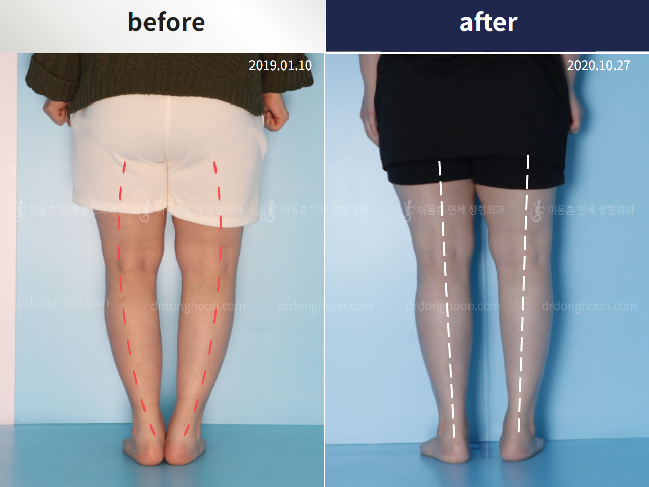 Before and after congenital condition, case 5271121, image 3, Dr. Donghoon institute (DALRI)