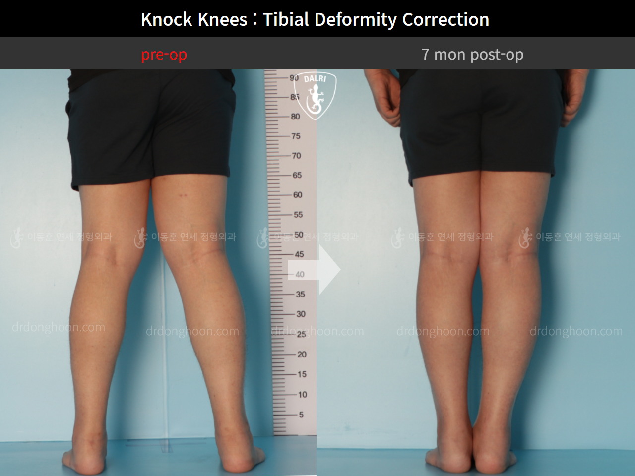 Before and after adult knock knees, case 9393967, image 4, Dr. Donghoon institute (DALRI)