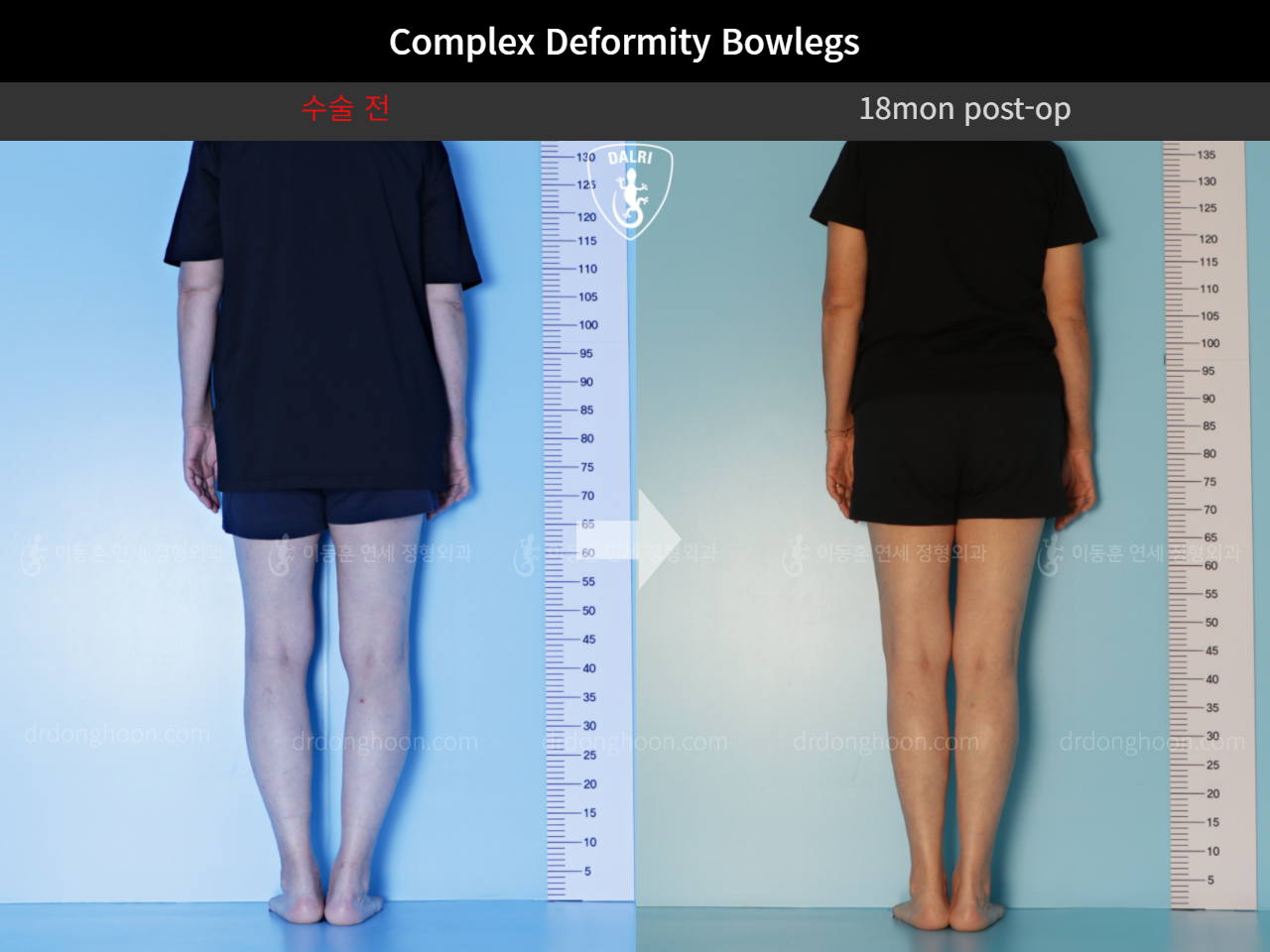 Before and after adult bowlegs, case 11337461, image 4, Dr. Donghoon institute (DALRI)