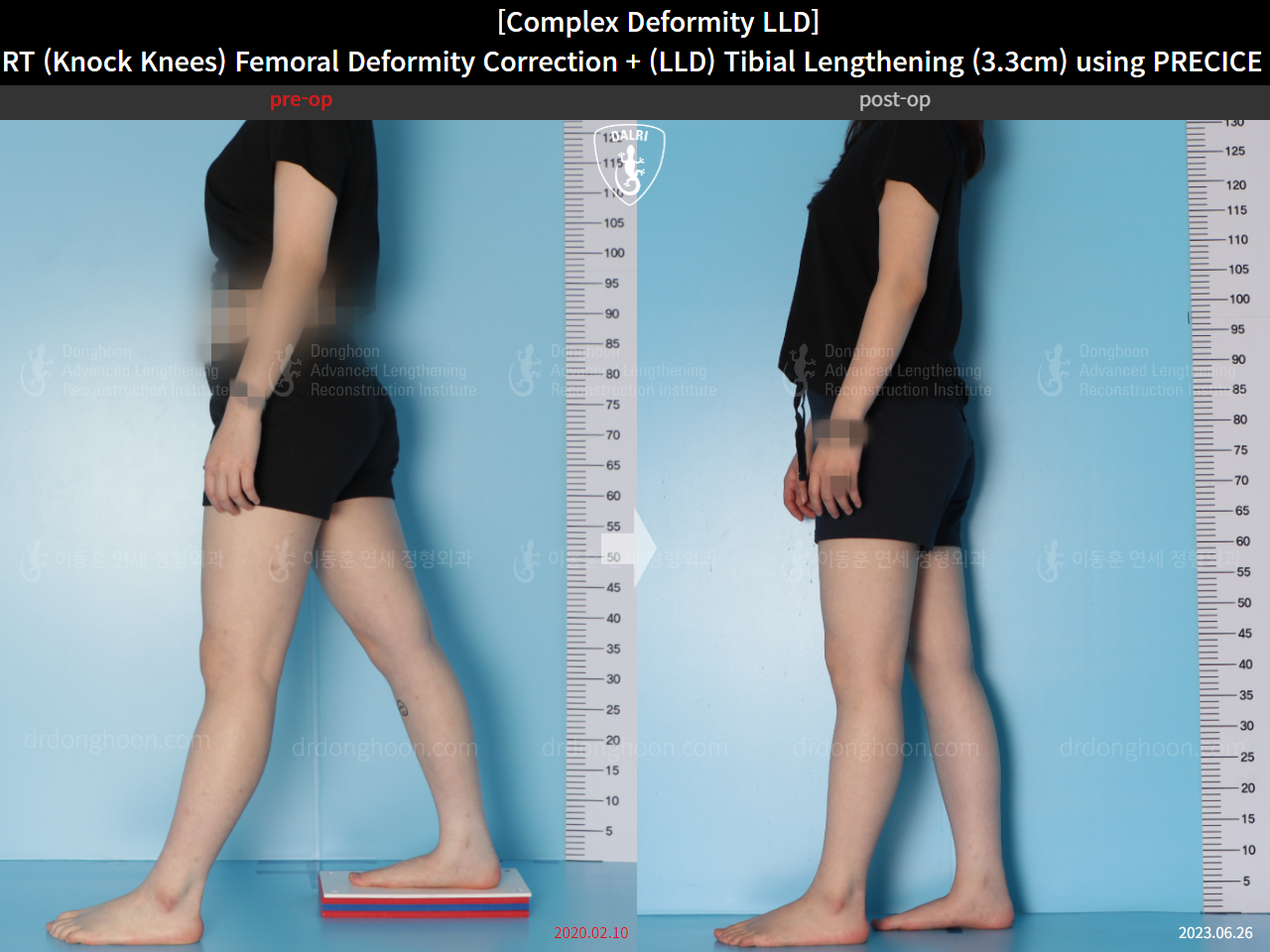 Before and after adult lld, case 15584036, image 3, Dr. Donghoon institute (DALRI)
