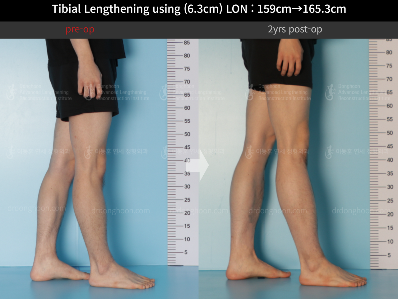 Before and after cll lon, case 12096536, image 9, Dr. Donghoon institute (DALRI)