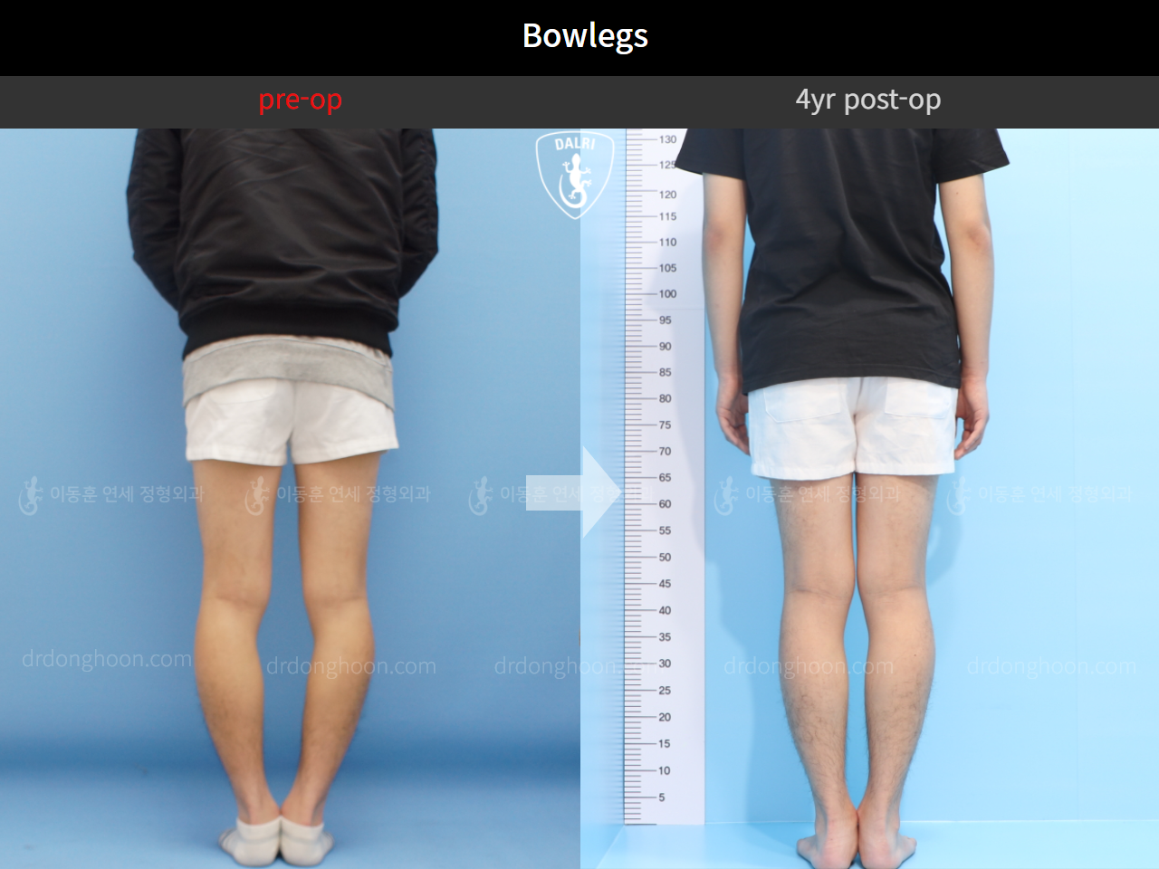 Before and after adult bowlegs, case 4311360, image 3, Dr. Donghoon institute (DALRI)