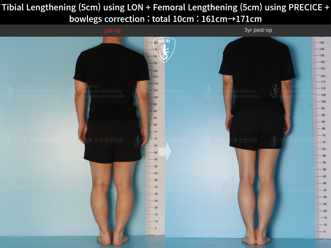Before and after cll precice, case 22208321, image 4, Dr. Donghoon institute (DALRI)