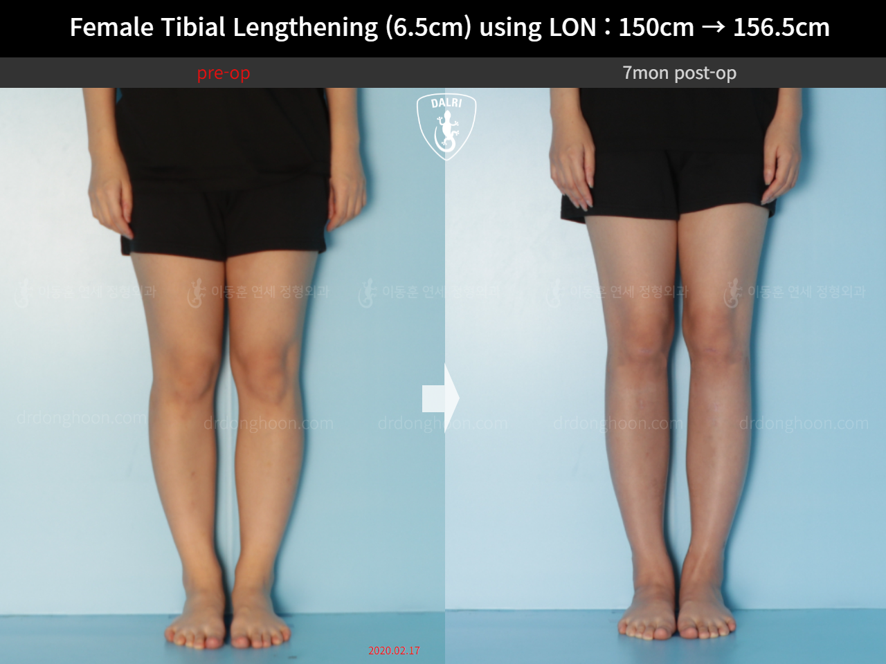 Before and after cll lon, case 16061220, image 5, Dr. Donghoon institute (DALRI)