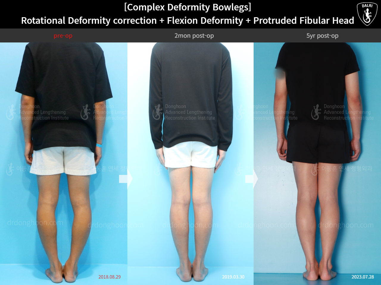 Before and after adult bowlegs, case 15944746, image 2, Dr. Donghoon institute (DALRI)