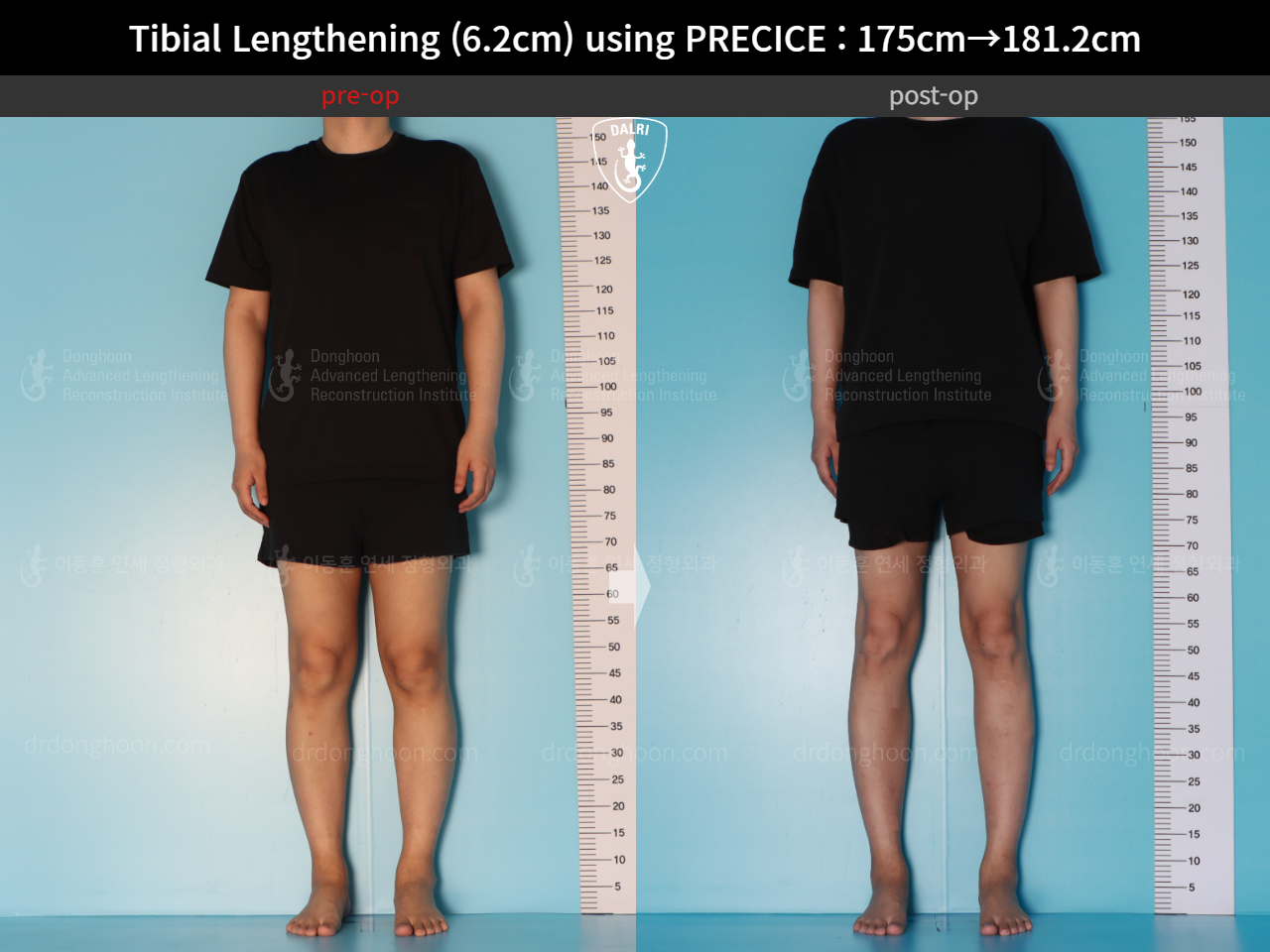 Before and after cll precice, case 16277428, image 2, Dr. Donghoon institute (DALRI)
