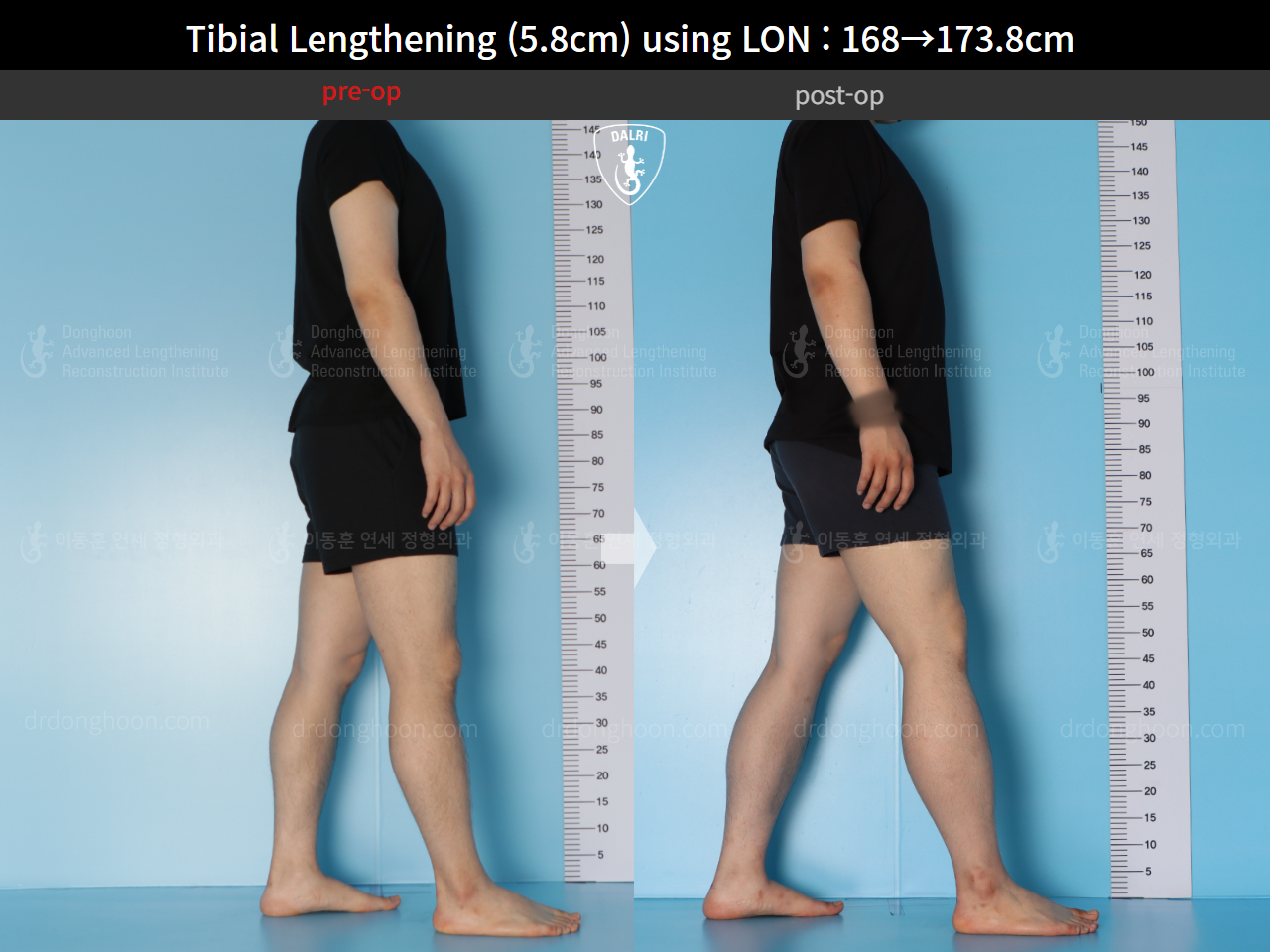 Before and after cll lon, case 15625788, image 3, Dr. Donghoon institute (DALRI)