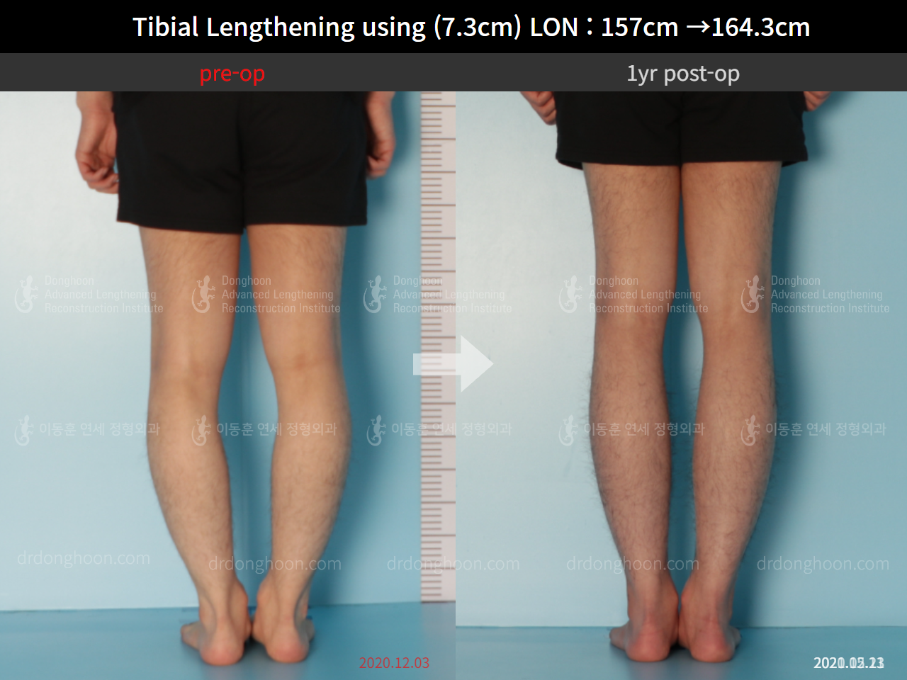 Before and after cll lon, case 9114235, image 6, Dr. Donghoon institute (DALRI)