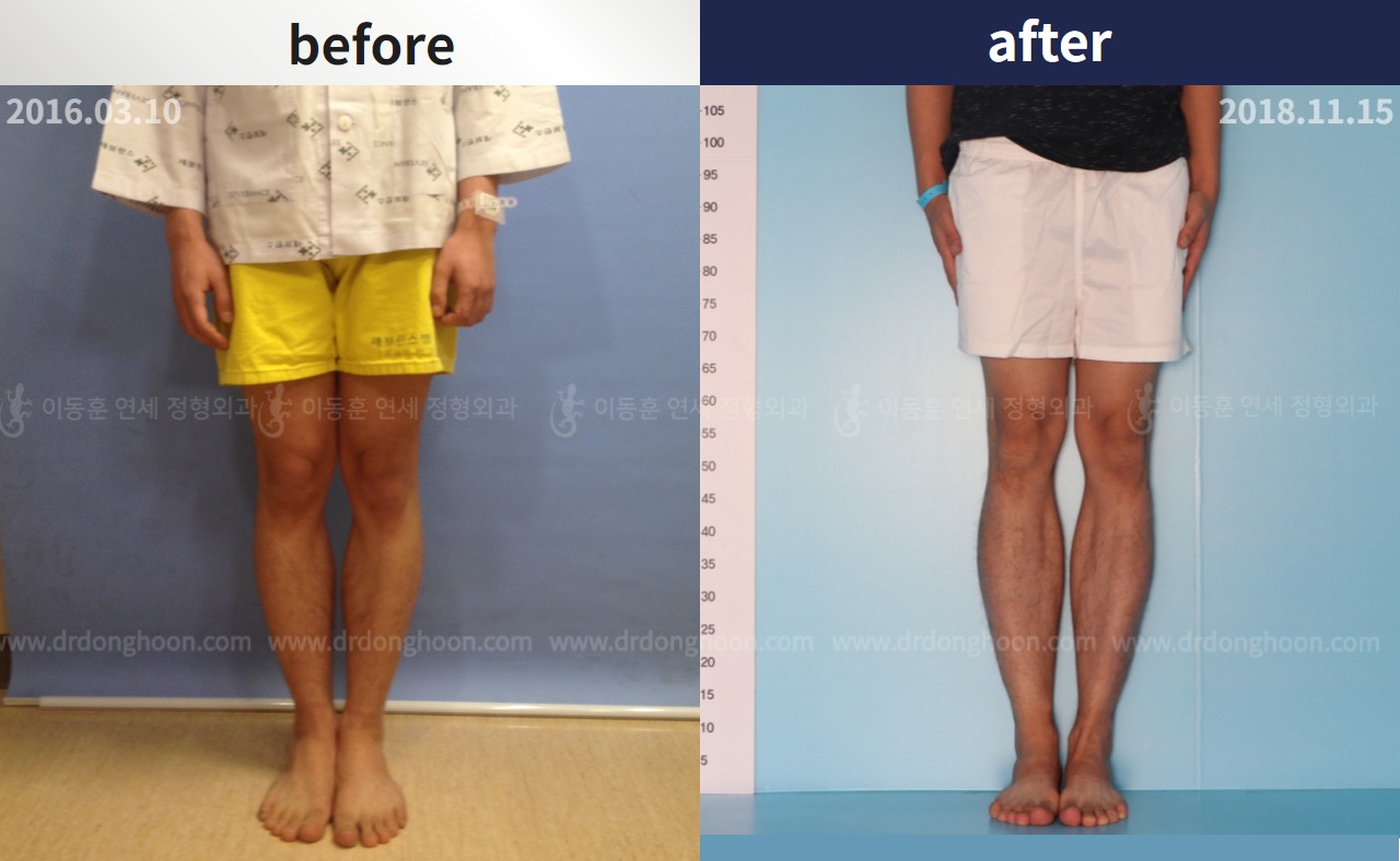 Before and after cll lon, case 4323449, image 1, Dr. Donghoon institute (DALRI)
