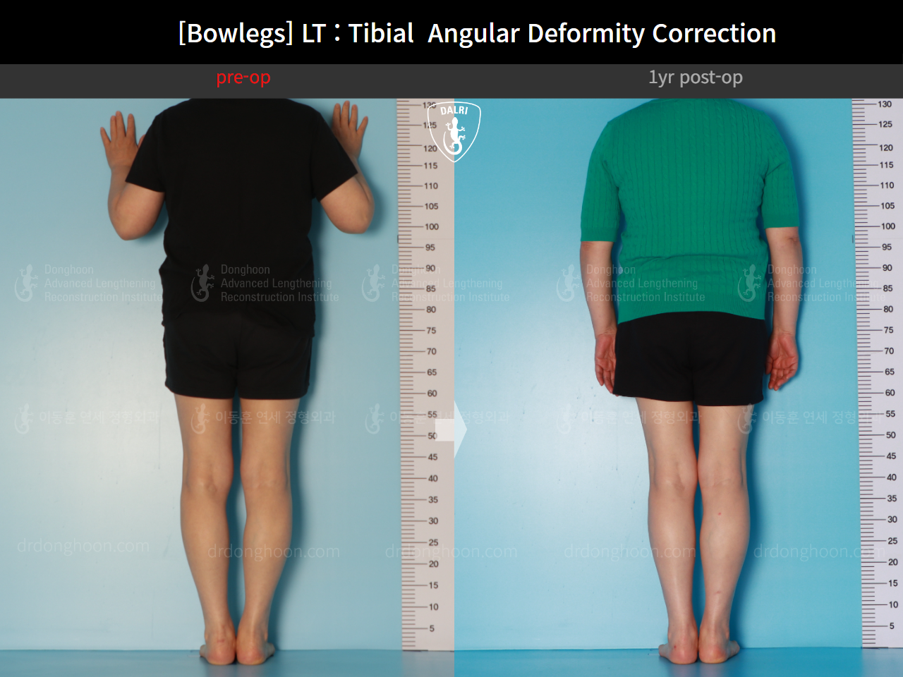 Before and after adult bowlegs, case 16787003, image 5, Dr. Donghoon institute (DALRI)