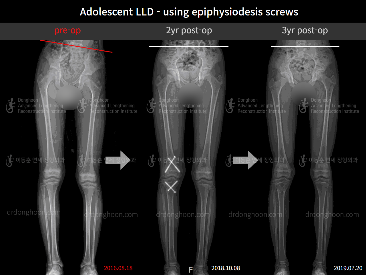 Before and after paediatric & adolescent lld, case 4320386, image 5, Dr. Donghoon institute (DALRI)
