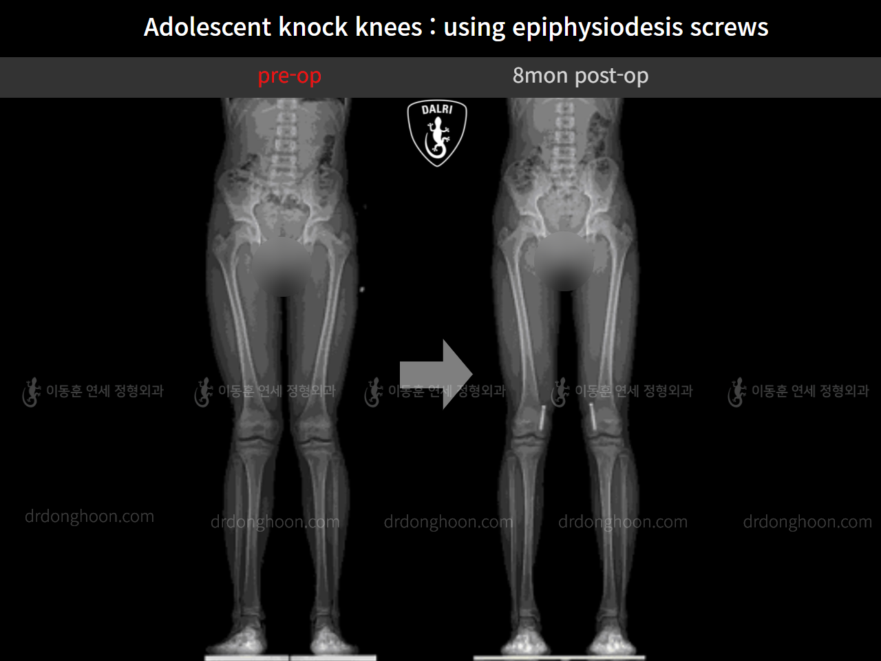 Before and after paediatric & adolescent knock knees, case 10171145, image 9, Dr. Donghoon institute (DALRI)