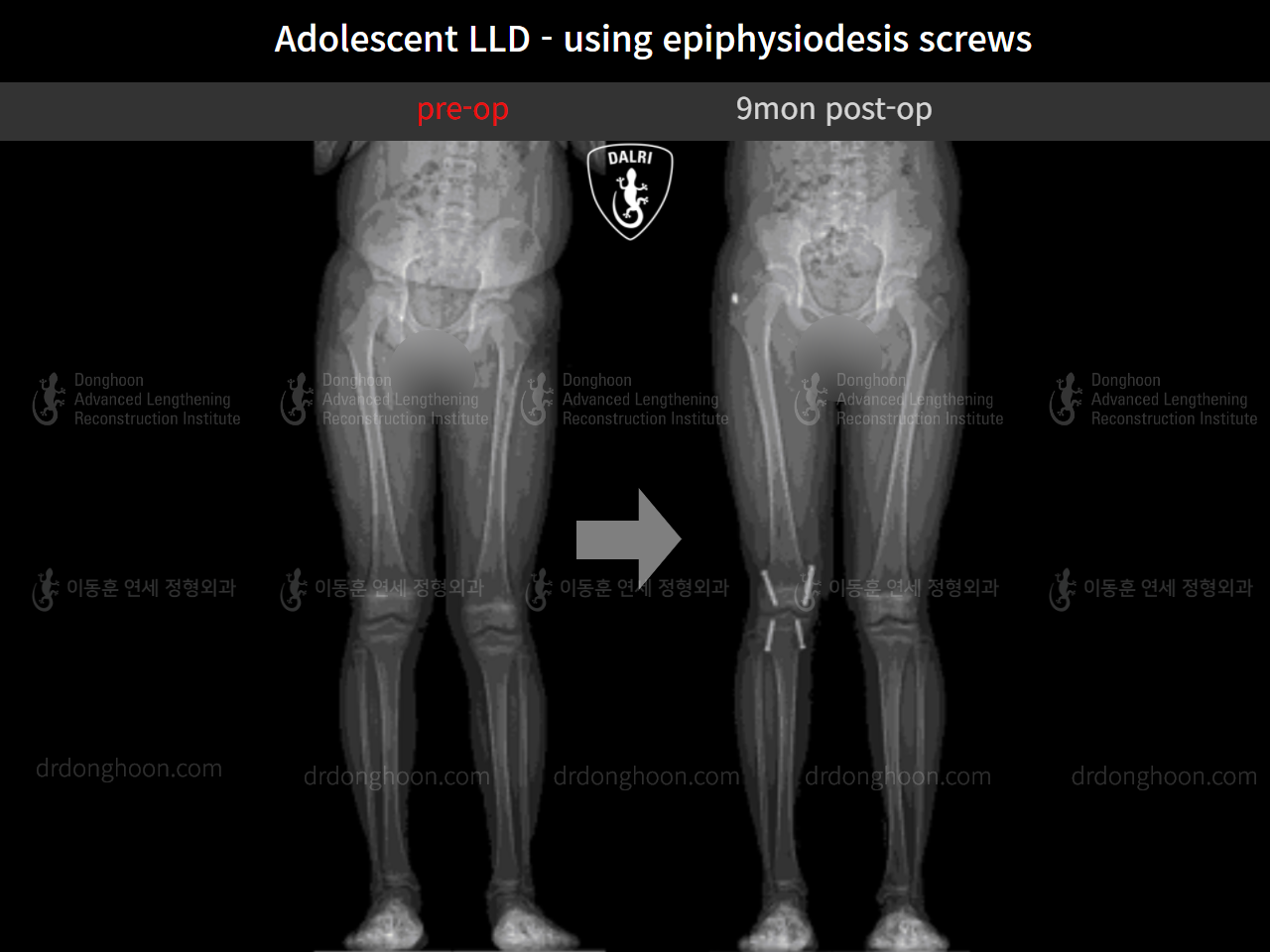 Before and after paediatric & adolescent lld, case 9572577, image 6, Dr. Donghoon institute (DALRI)