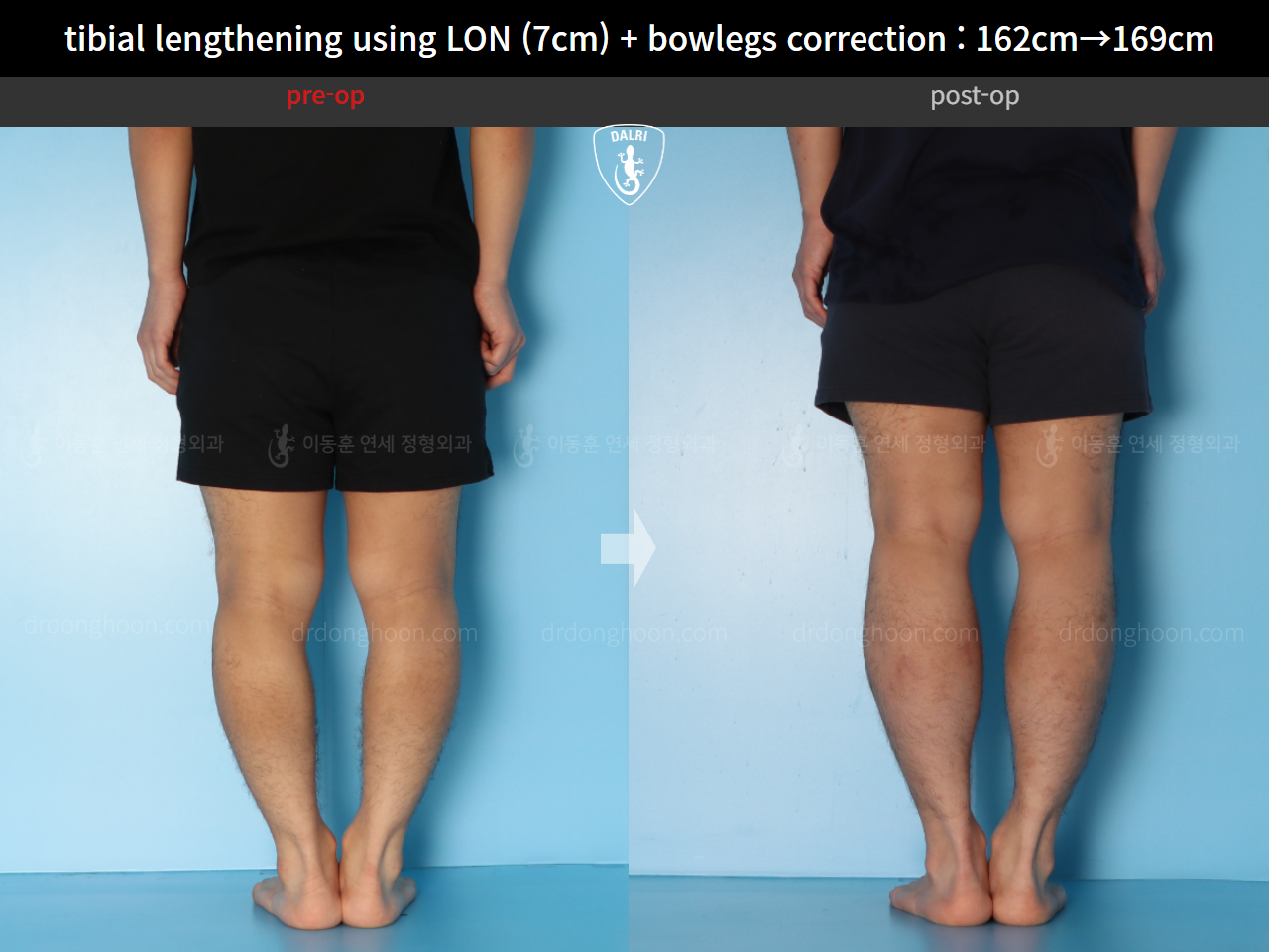Before and after cll + deformity correction, case 15545055, image 6, Dr. Donghoon institute (DALRI)