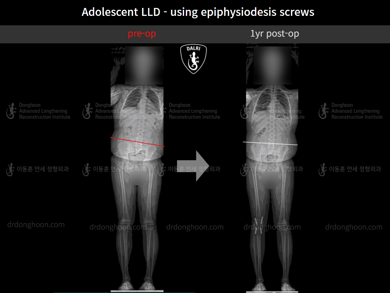 Before and after paediatric & adolescent lld, case 10291768, image 7, Dr. Donghoon institute (DALRI)