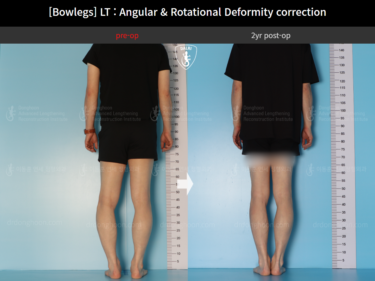 Before and after adult bowlegs, case 15111863, image 4, Dr. Donghoon institute (DALRI)