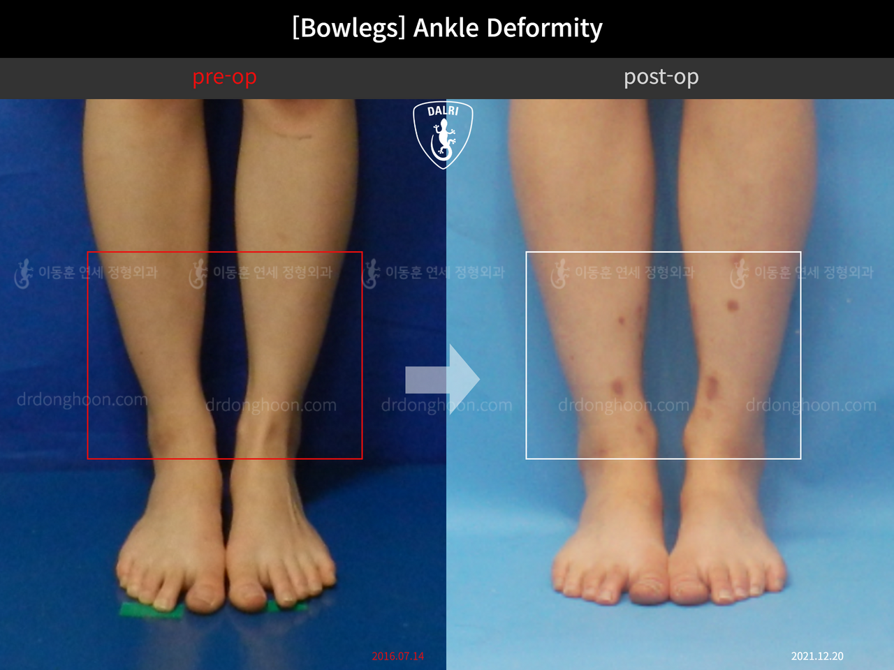 Before and after foot & ankle deformity, case 12754696, image 4, Dr. Donghoon institute (DALRI)
