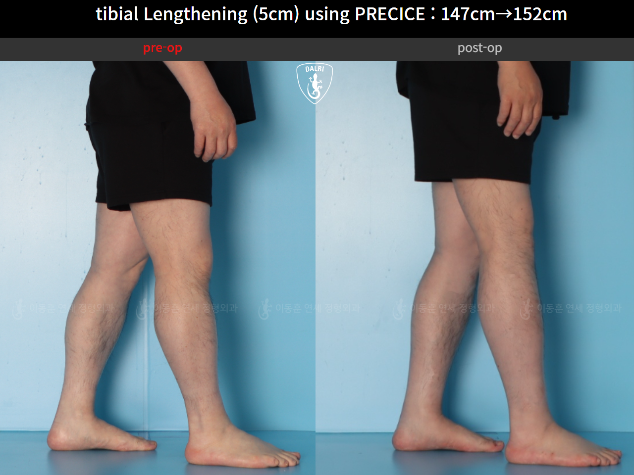 Before and after cll precice, case 89098588, image 10, Dr. Donghoon institute (DALRI)