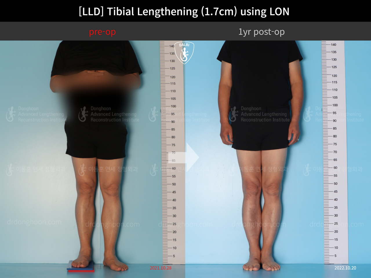 Before and after adult lld, case 13261805, image 1, Dr. Donghoon institute (DALRI)