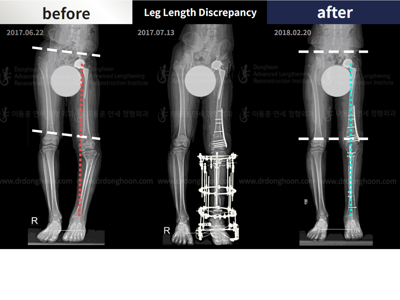 Before and after post-trauma deformity, case 4361765, image 4, Dr. Donghoon institute (DALRI)