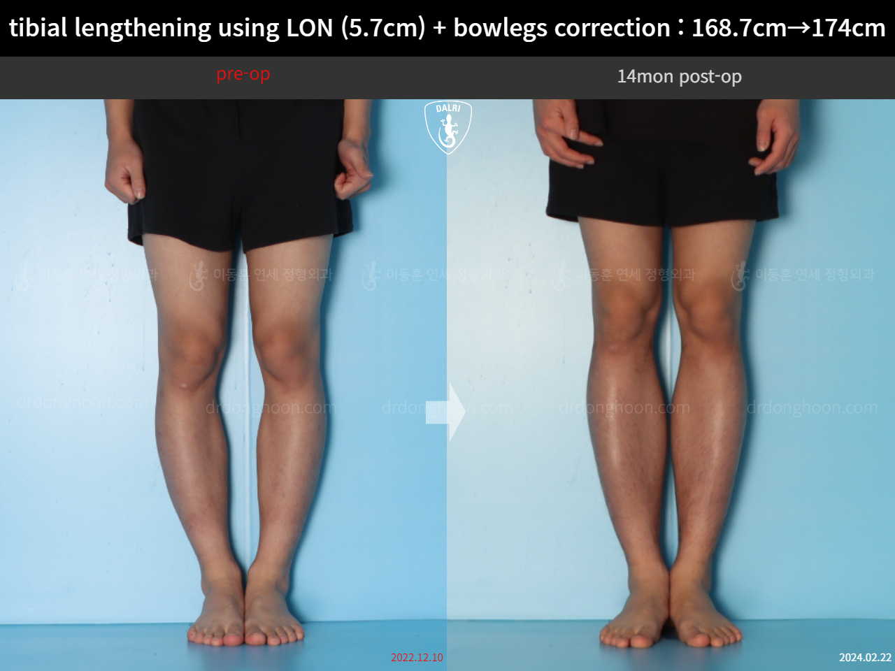 Before and after cll + deformity correction, case 18160780, image 7, Dr. Donghoon institute (DALRI)