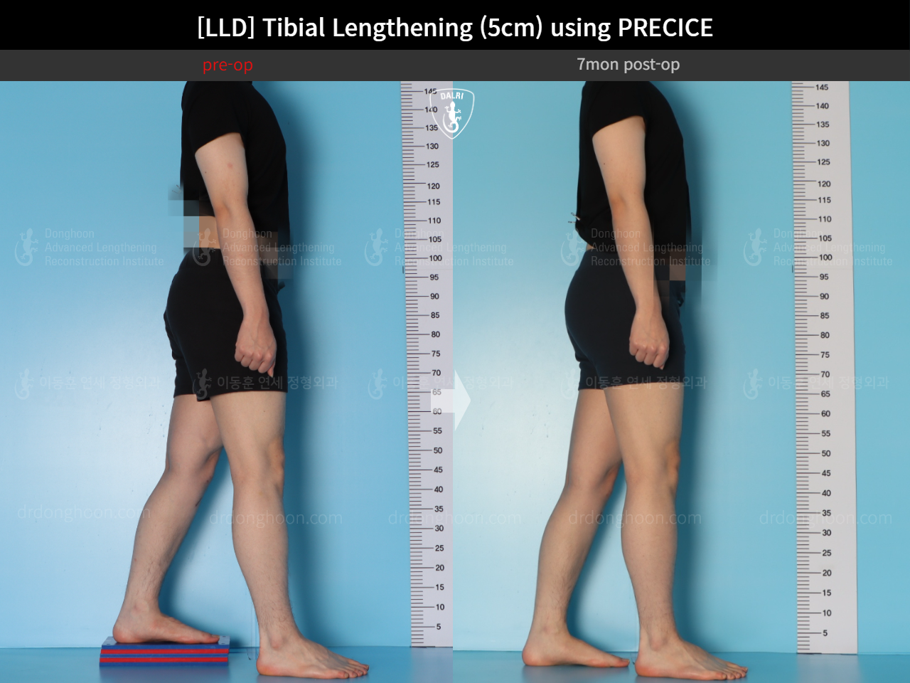 Before and after adult lld, case 18471613, image 4, Dr. Donghoon institute (DALRI)