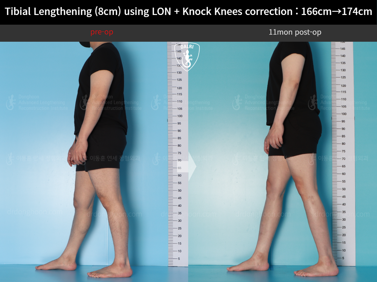 Before and after cll + deformity correction, case 20789954, image 6, Dr. Donghoon institute (DALRI)