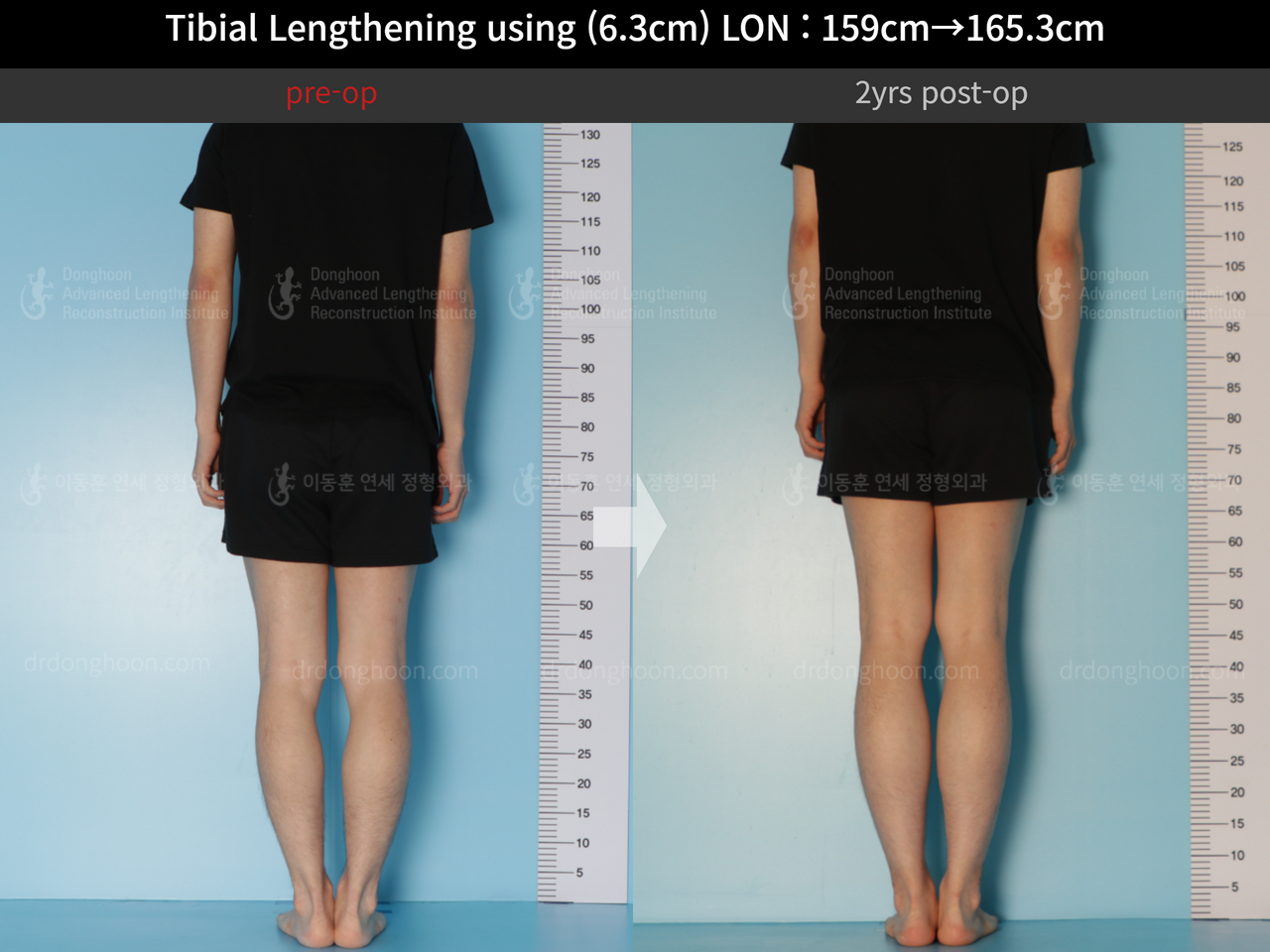 Before and after cll lon, case 12096536, image 4, Dr. Donghoon institute (DALRI)