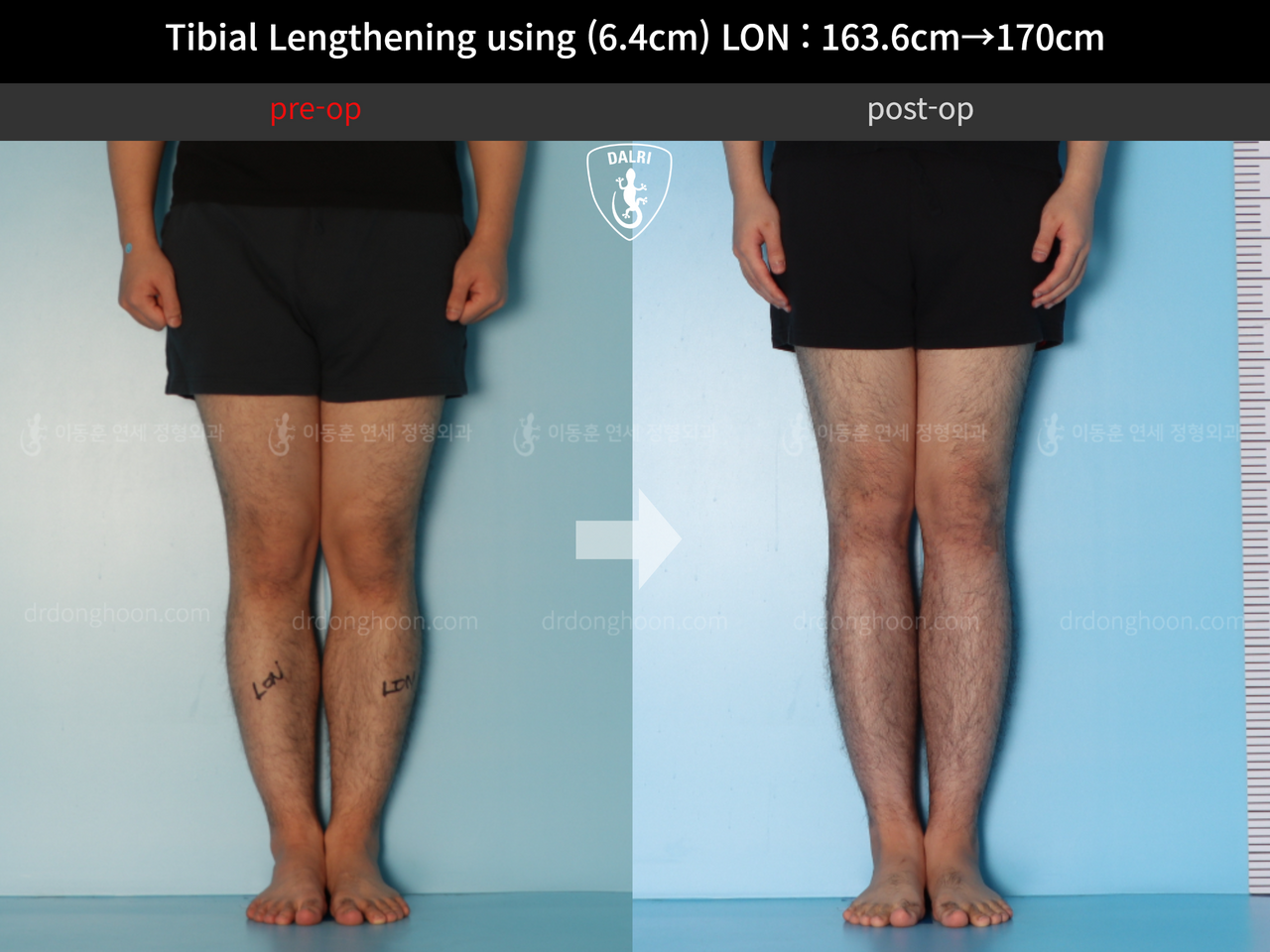 Before and after cll lon, case 12779092, image 5, Dr. Donghoon institute (DALRI)