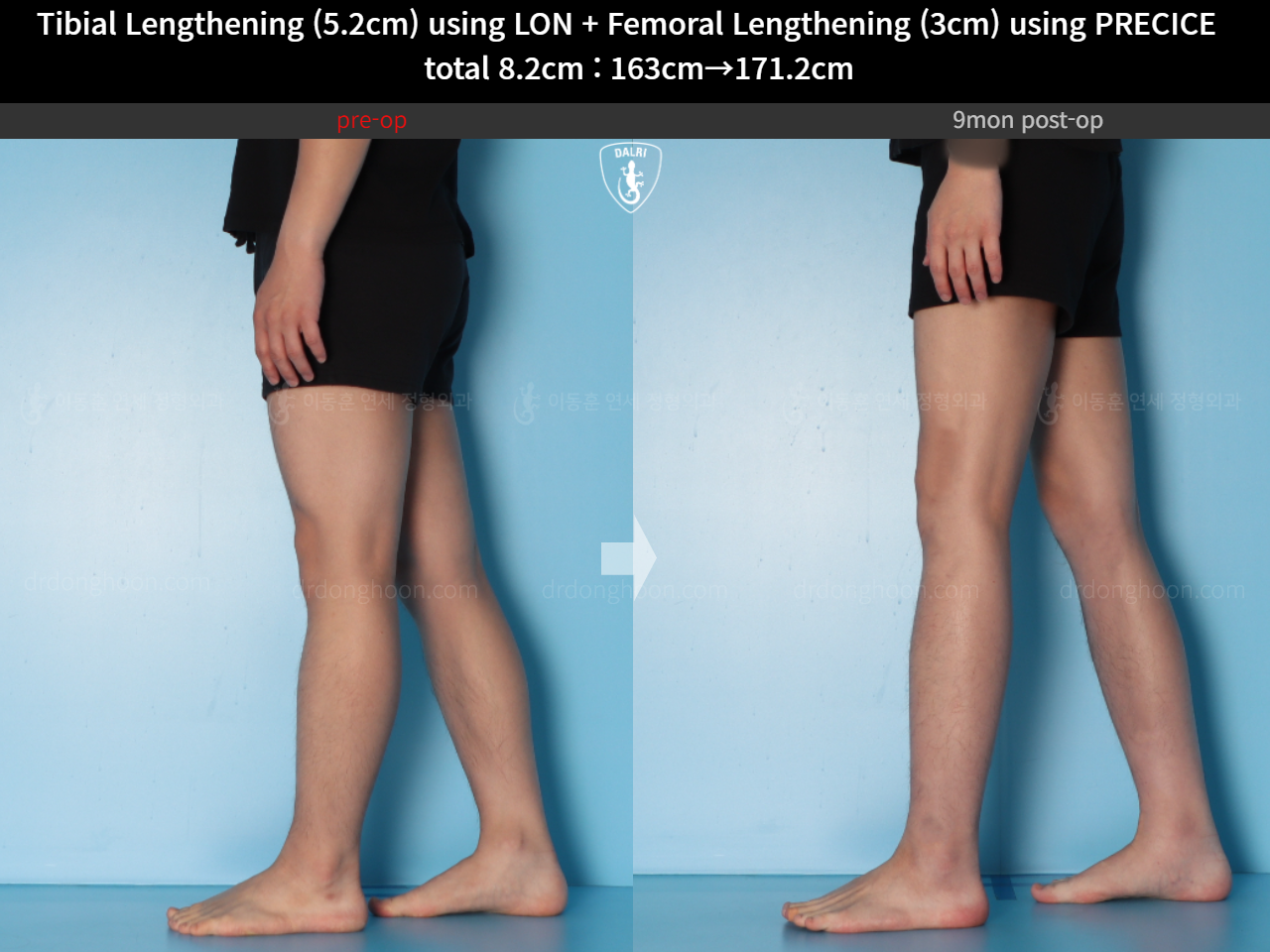 Before and after cll lon, case 15203339, image 13, Dr. Donghoon institute (DALRI)