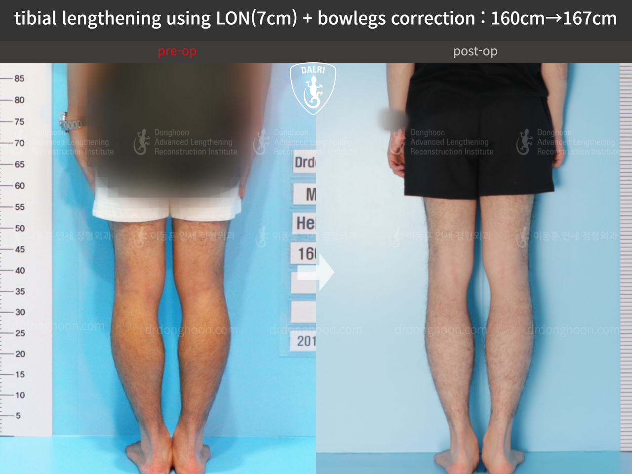 Before and after cll + deformity correction, case 13241722, image 6, Dr. Donghoon institute (DALRI)