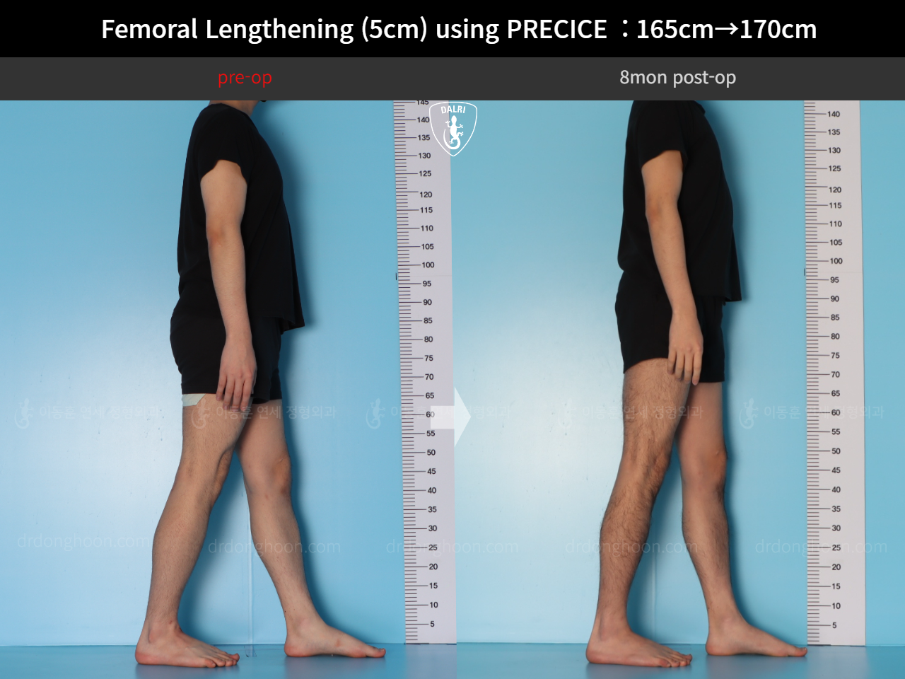 Before and after cll precice, case 18356944, image 6, Dr. Donghoon institute (DALRI)