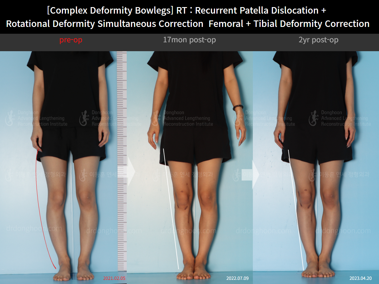 Before and after adult bowlegs, case 14960899, image 1, Dr. Donghoon institute (DALRI)