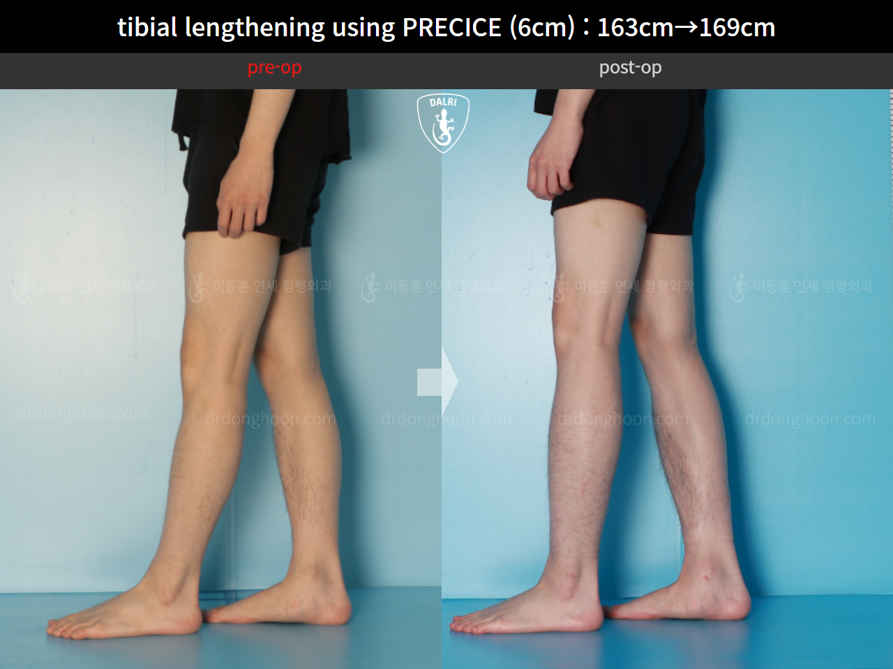 Before and after cll precice, case 16061529, image 10, Dr. Donghoon institute (DALRI)