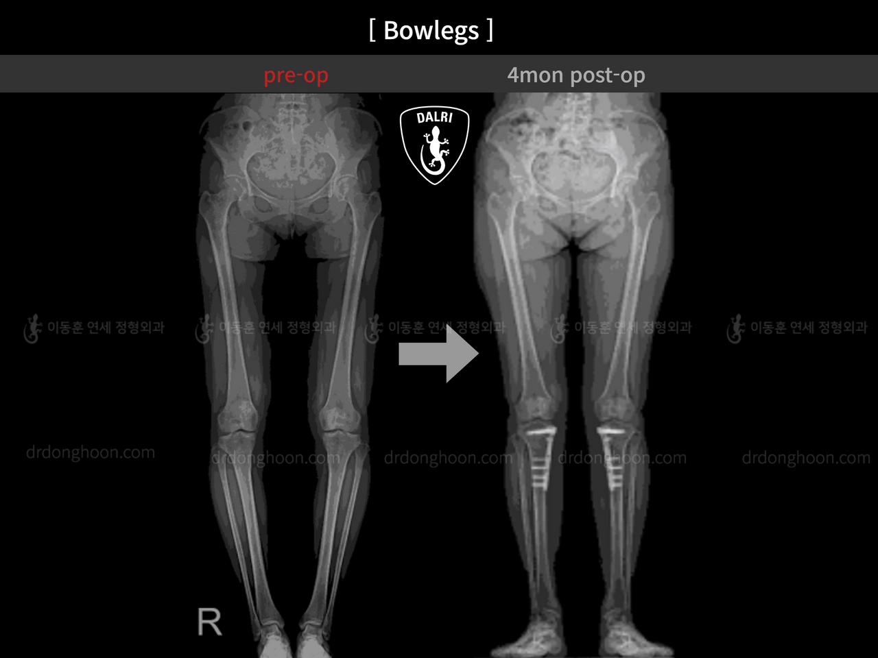 Before and after adult bowlegs, case 12060396, image 8, Dr. Donghoon institute (DALRI)